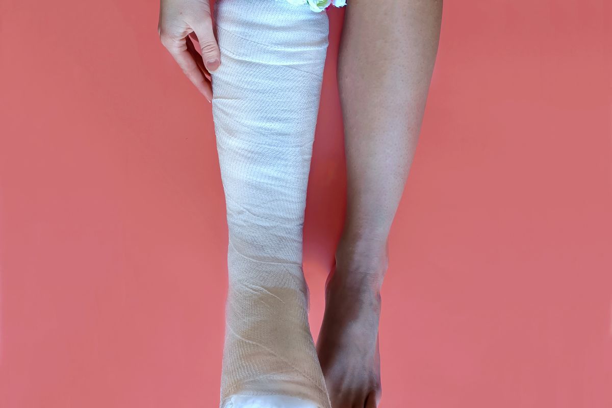 A leg in a plaster cast A leg in a plaster cast